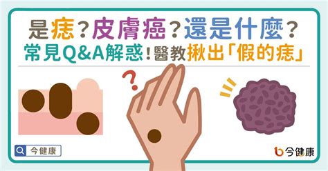 為什麼會長痣|是痣or皮膚癌？醫「1張圖秒對照」 長這2部位最危險